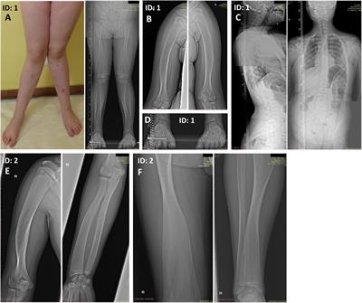 The First Report of Biallelic Missense Mutations in the SFRP4 Gene Causing Pyle Disease in Two Siblings